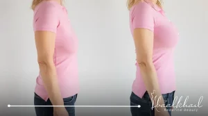 صور عمليات شد الثدي قبل وبعد.