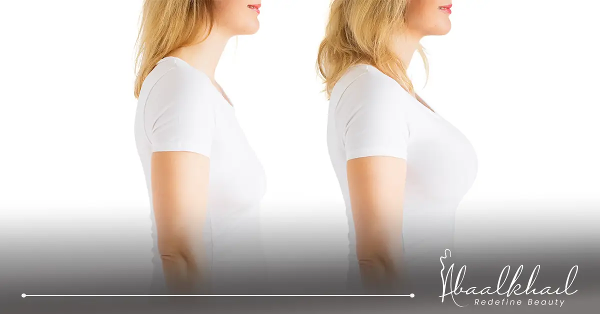 عمليات شد الثدي قبل وبعد.