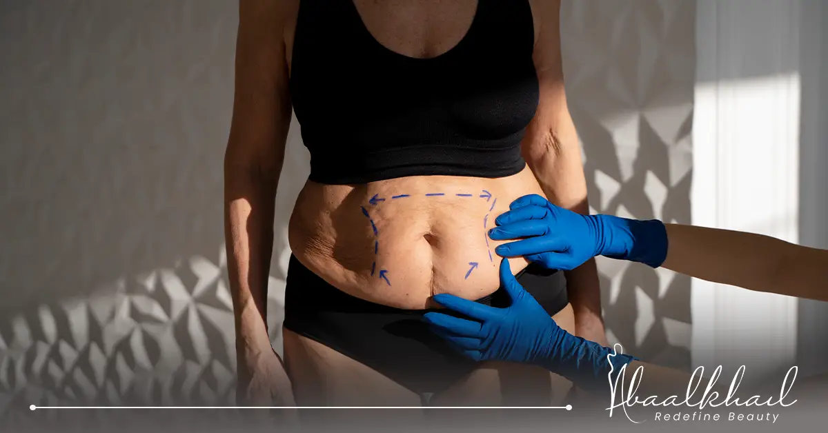 عملية شد البطن بعد الولادة القيصرية.