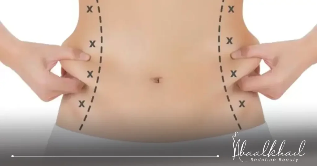 عملية نحت الخصر.