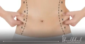 عملية نحت الخصر.