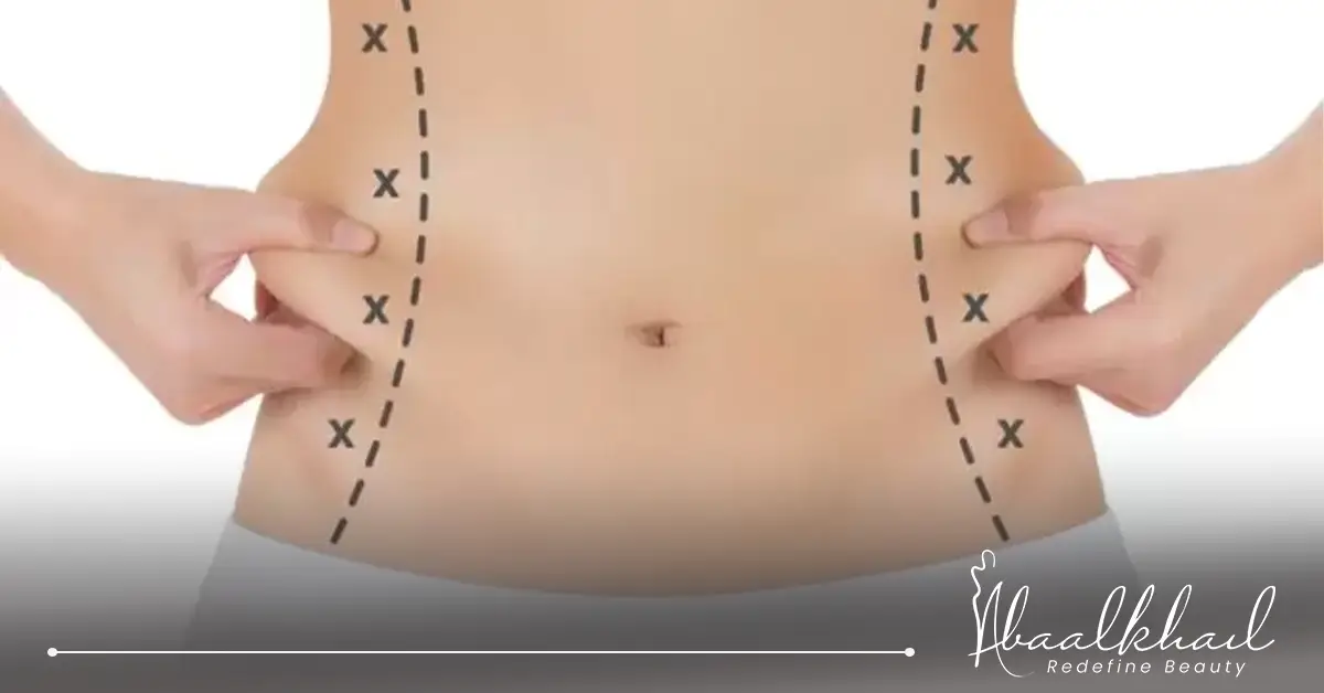 عملية نحت الخصر.