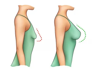 شد الثدي بالخيوط والليزر قبل وبعد