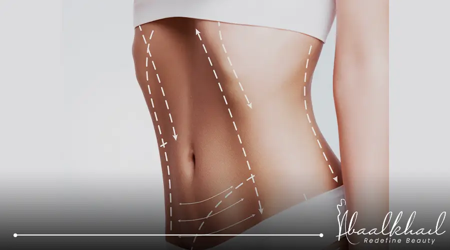 عملية شفط الدهون من البطن بالفيزر