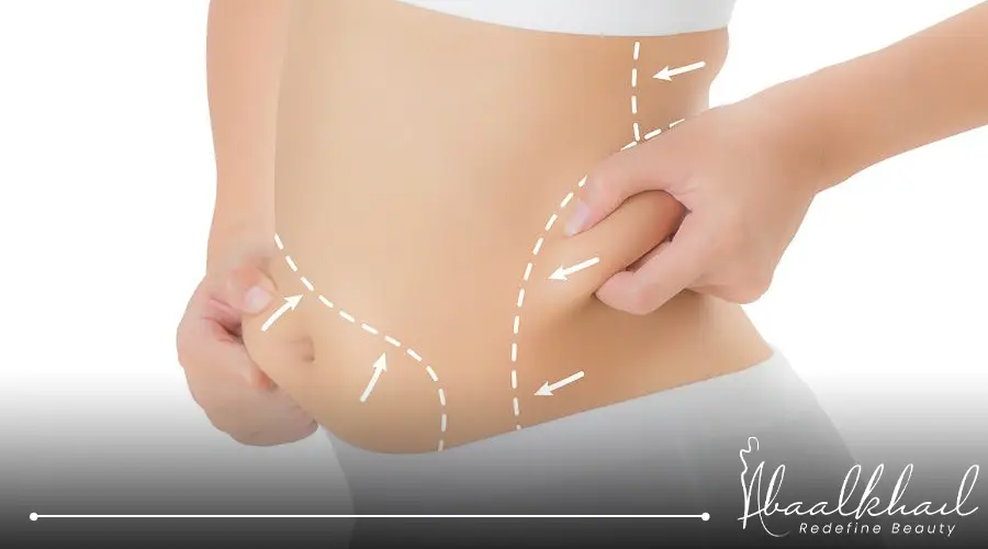 عيوب شفط الدهون بالفيزر