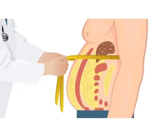 ​عملية شفط الدهون من البطن بالفيزر في السعودية وتفاصيلها