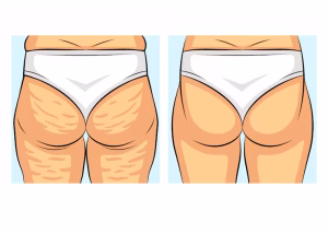 شد ترهلات الفخذين