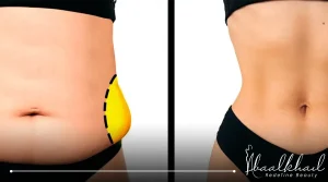 نتيجة شفط الدهون بالفيزر قبل وبعد العملية بالصور والتي تظهر فرق واضح في نتيجة إيجابية في الجسم.